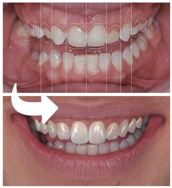 Simulação de antes e depois com DSD